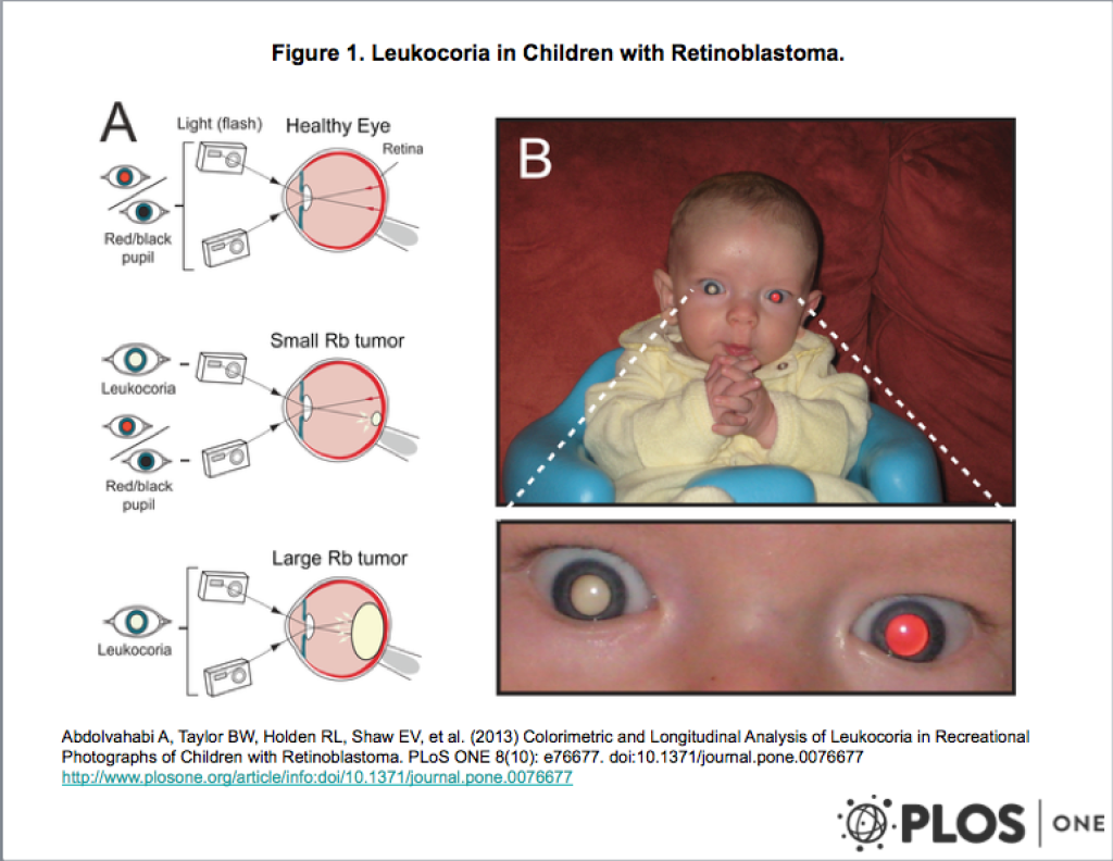 retinoblastom_test_1